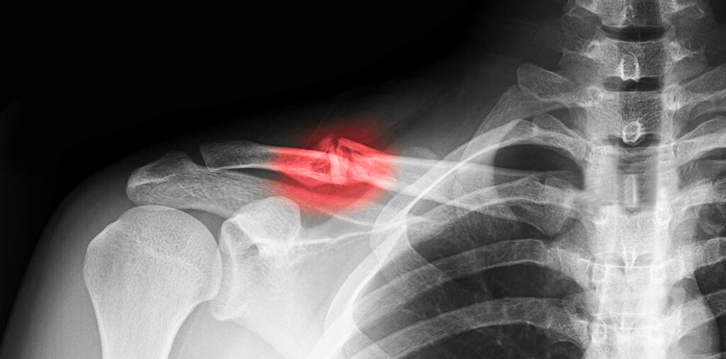 La rééducation après une fracture de la clavicule Institut de — free download